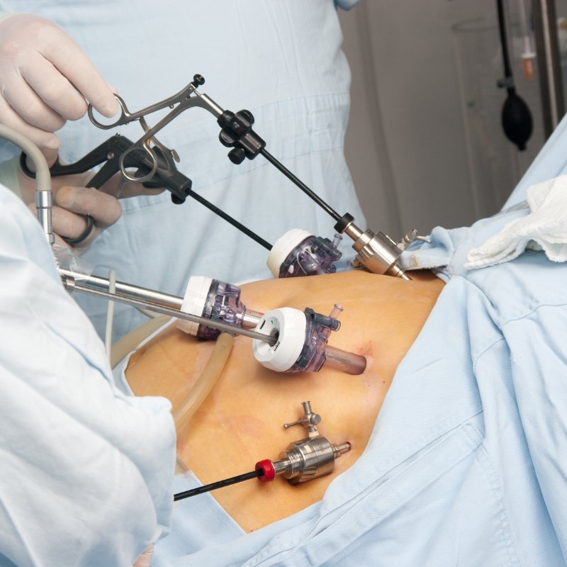 Cirugía de Apendicitis Laparoscópica